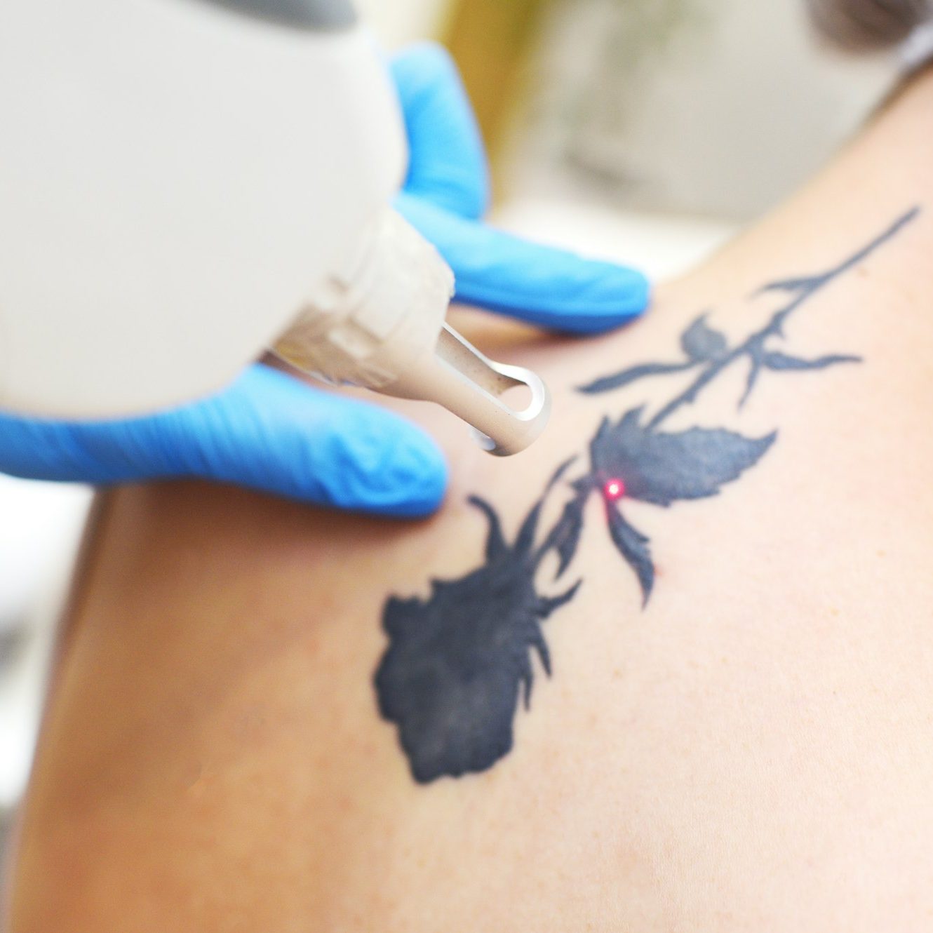 Laser Tattoo Removal