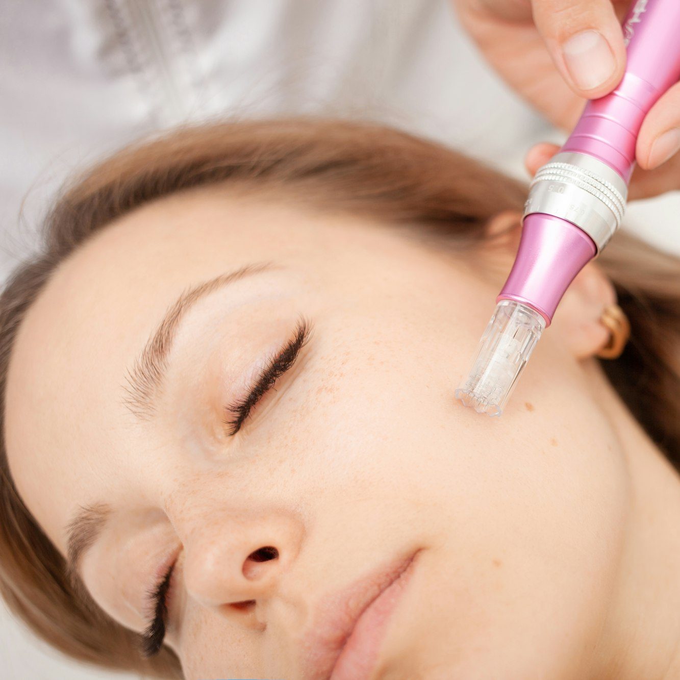 Microneedling